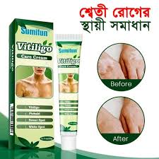 Sumifun Vitiligo Cream Reduces White Spots and Improves Skin Pigmentation 20gram